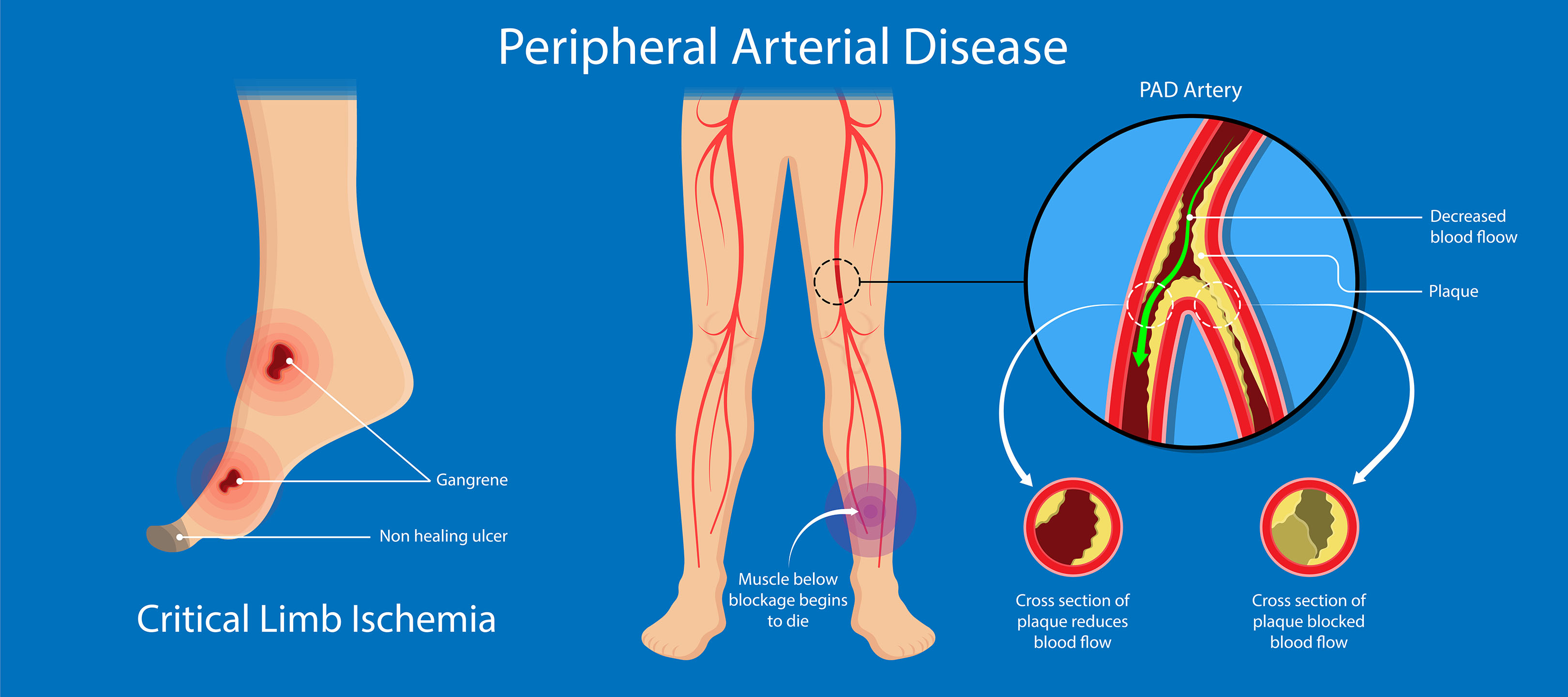 critical_limb_ischemia image Image